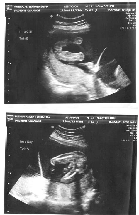 tyler  lissy  week ultrasound pics
