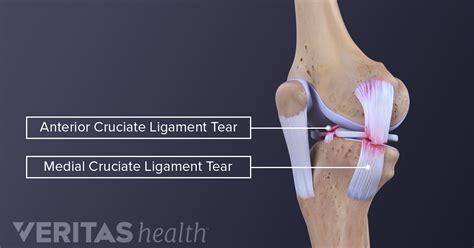 medial collateral ligament mcl tears  sprains