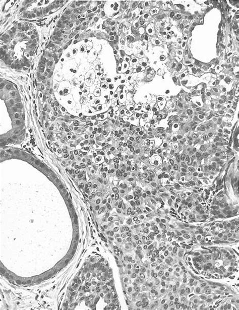 pathology outlines juvenile papillomatosis