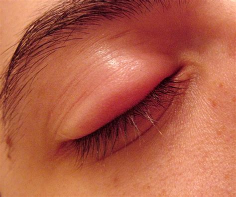 swollen eyelid symptoms treatment pictures  hubpages