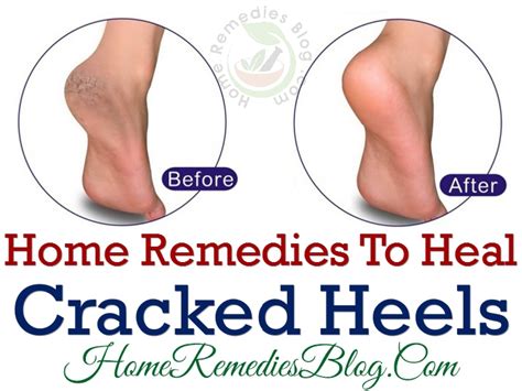 11 fast natural remedies for cracked heels and prevention tips home