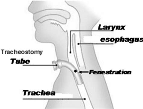 The Trachea Tracheostomy Tube And Surrounding Structures Download