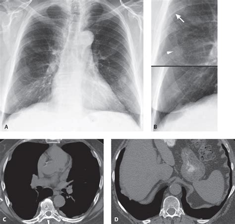 173 Asbestos Related Pleural Plaques Radiology Key