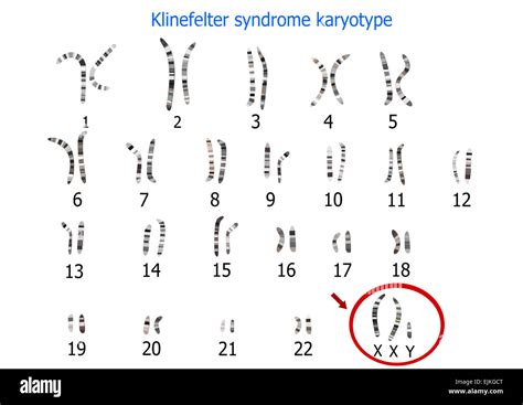Klinefelter Syndrome In Female