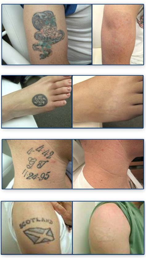 tattoo removal cost close  wallet  find