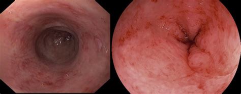 long term follow up of transgender women after secondary intestinal