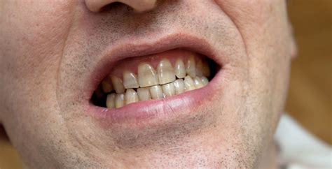 Is Smoking Bad For Your Teeth Old Milton Dental Alpharetta Ga
