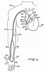 Coronary Catheter Catheterization Artery Transradial Patents Claims Catheters Right sketch template