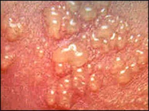 genital herpes pictures and symptoms in women — herpes free me