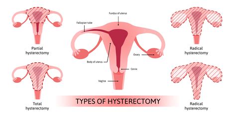 open hysterectomy understanding   means
