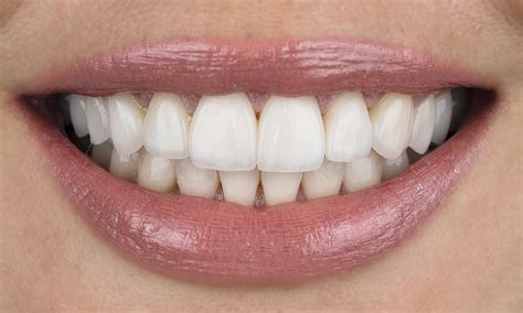 accendere il sorriso  denti bianchi  brillanti poliodontomedica milano