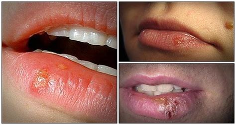 get to know 13 tips on how to get rid of cold sores naturally v kool