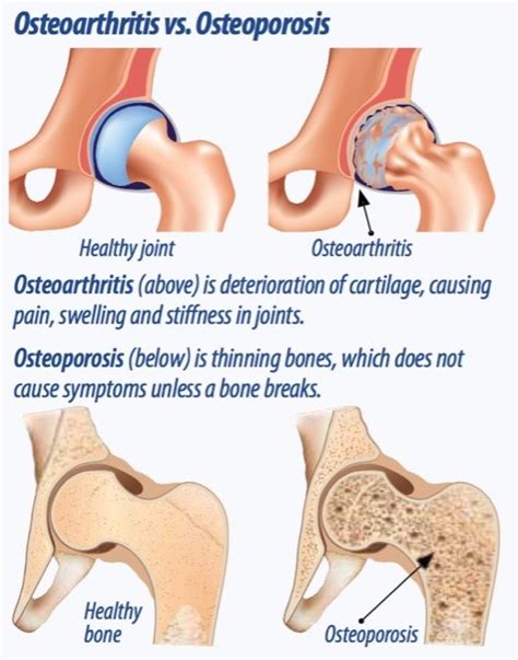 Osteoarthritis Vs Osteoporosis Arthritis Advisor