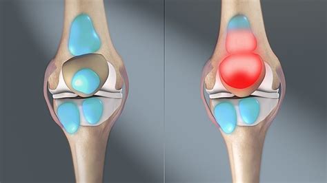 bursitis wikipedia