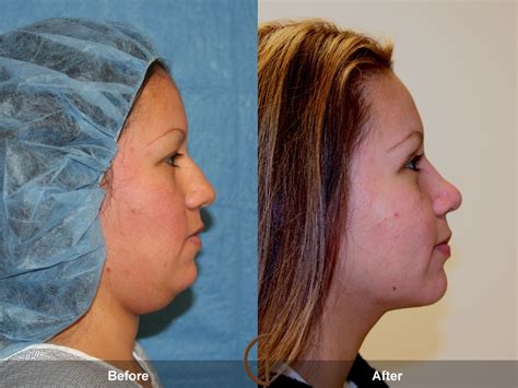 rhinoplasty nose surgery orange county ca before after photo 1