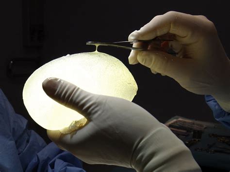 Woman Who Tripped And Ruptured Breast Implant Wins 85 000 From San