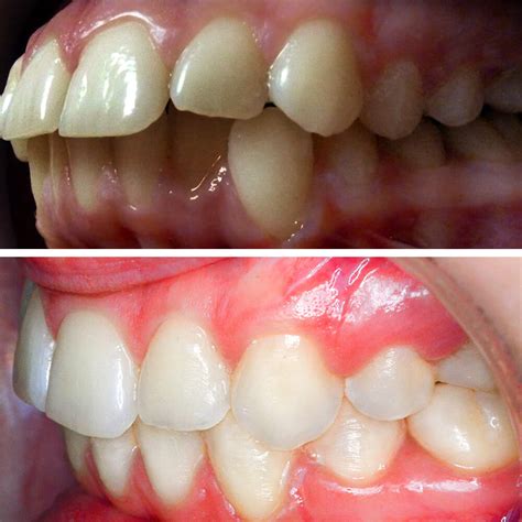 upper   teeth protrusion cabinet stomatologic