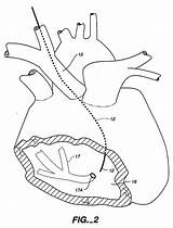 Patents Coronary Catheter Sinus sketch template