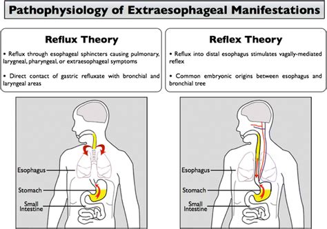 Extra Esophageal Manifestations Of Gastroesophageal Reflux Disease