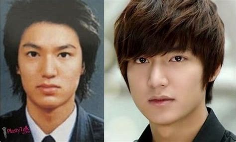 Korean Guy Plastic Surgery Before After Plastic Surgery
