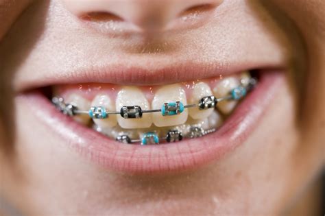 coloured braces guildford orthodontic centre surrey bc