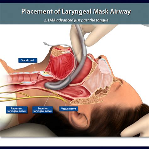 Placement Of Laryngeal Mask Airway Trialexhibits Inc