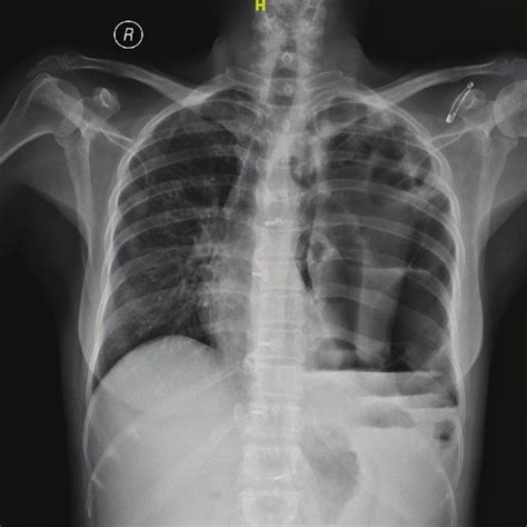Patient 2 Chest Radiograph Showing Left Upper Lobe Cavity And