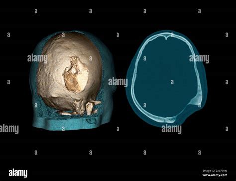 Gorhams Disease Coloured 3d Left And 2d Right Computed Tomography