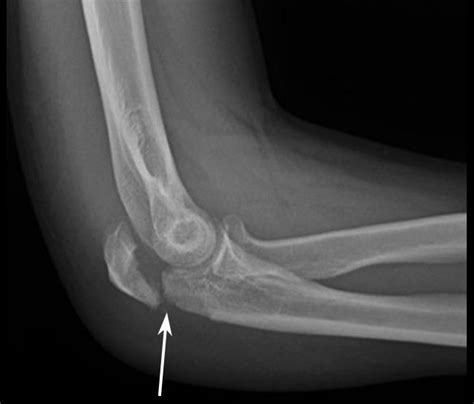 elbow fracture  iran jam hospital  tehran irantreatments