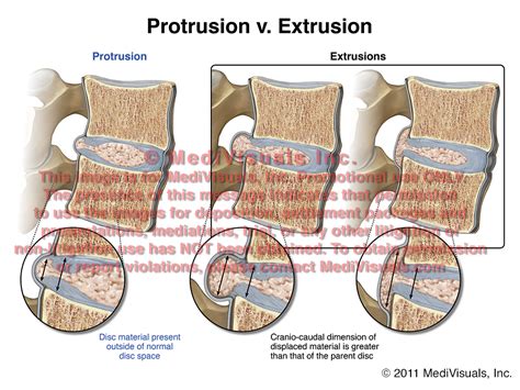 medical legal exhibit expert blog protrusions  extrusions