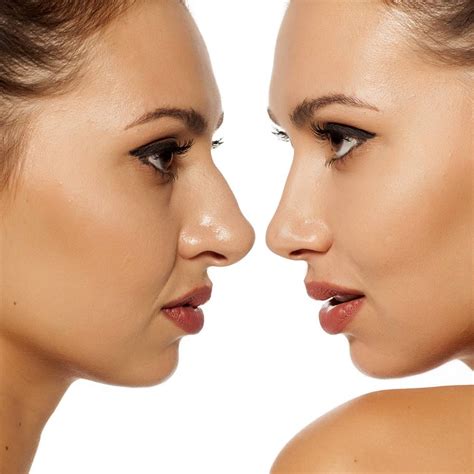 rifarsi il naso  difetti estetici risolvibili  la chirurgia estetica del naso