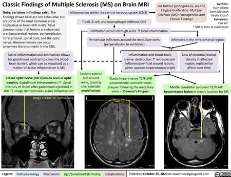 Multiple Sclerosis On Brain Mri Calgary Guide