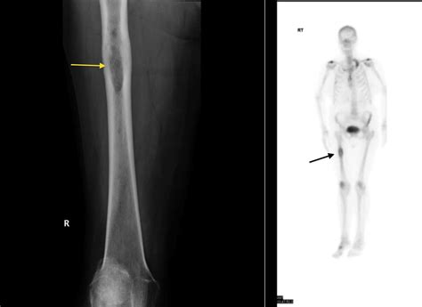 Bone Metastasis Radiology At St Vincents University Hospital