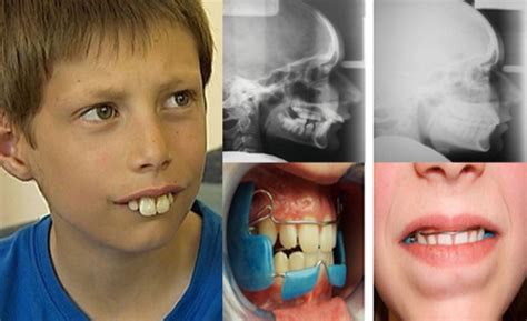buck teeth pictures symptoms  treatment headgear braces