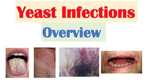 Candidal Yeast Infections Overview Oral Thrush Vaginal Intertrigo