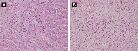 the clinical spectrum of hepatic manifestations in chronic lymphocytic