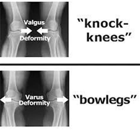 valgus  varus google search orthopedics physical evaluation
