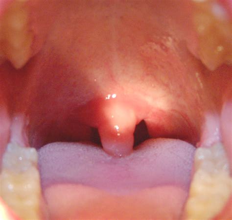 swollen uvula  symptoms pictures treatment  prevention drug details