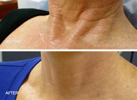 neck décolletage and hand rejuvenation dr may marr