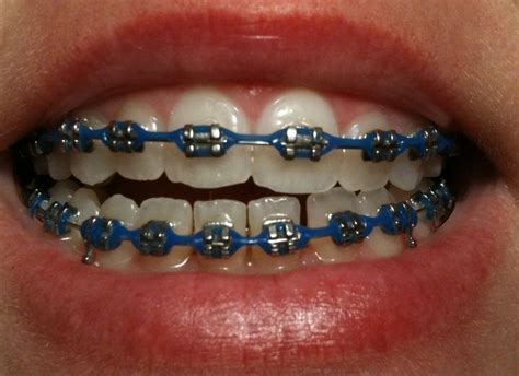gorgeous braces color ideas you haven t considered healthy lifestyle