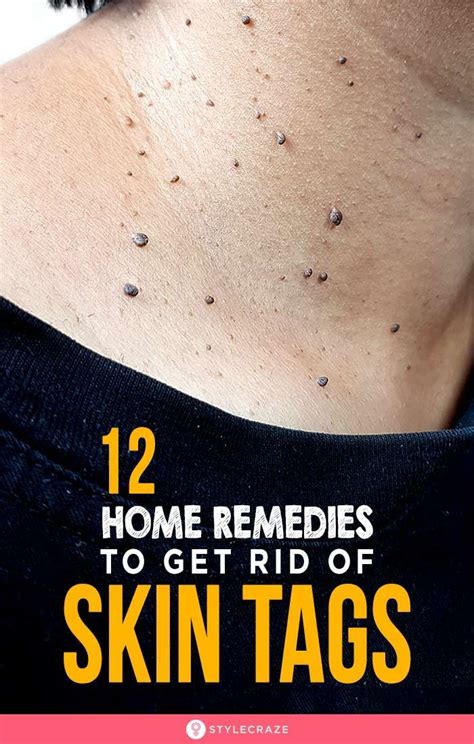 12 effective home remedies to remove skin tags remove skin tags