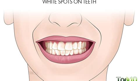 how to remove white spots from your teeth top 10 home