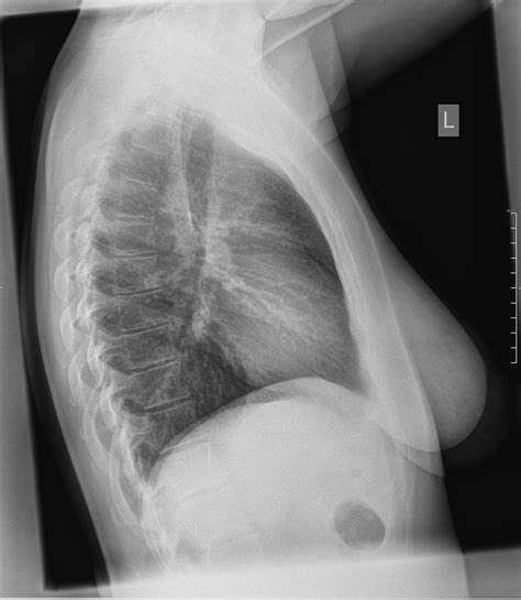 kann man eine lungenembolie beim thorax roentgen erkennen