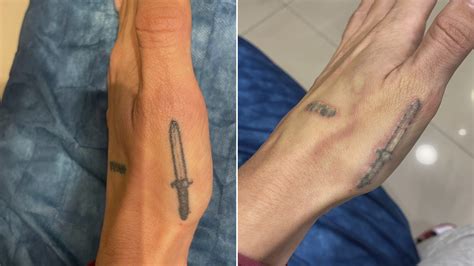 Borrar Los Tatuajes Es Posible Cómo Es La Nueva Tecnología Que Permite