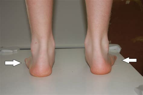 flat foot  symptoms treatment flat foot