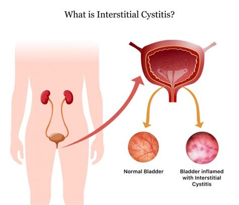 interstitial cystitis symptoms causes treatment and living with ic