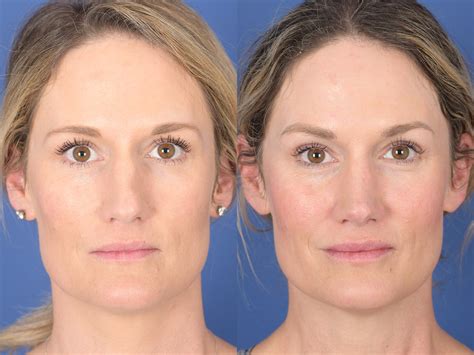 Rhinoplasty Before And After 97 Weber Facial Plastic Surgery