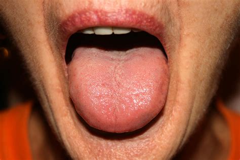 maladies de la bouche 3 causes possibles