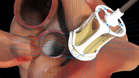 3d Animation Of Aortic Valve Replacement Surgery Showing