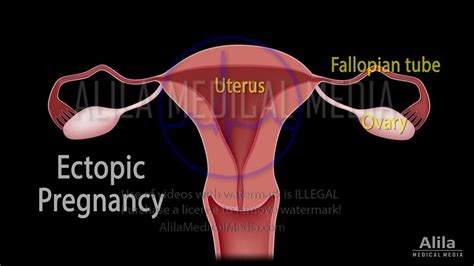Alila Medical Media Female Reproductive System Videos
